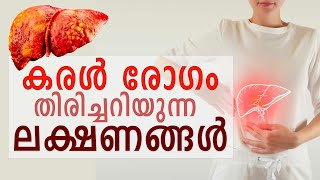 How to identify Hepatitis | കരൾ രോഗം തിരിച്ചറിയാനുള്ള ലക്ഷണങ്ങൾ | Ethnic Health Court