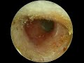 ultimate earwax removing experience