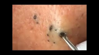 LARGE Blackheads Removal @@!!!