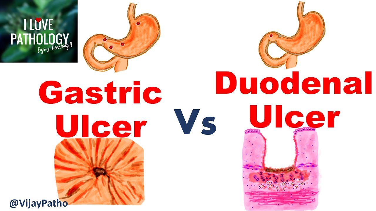 Peptic Ulcer Disease Gastric Duodenal Ulcers Causes 60 Off