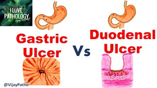 Peptic Ulcer Disease: GASTRIC VS DUODENAL ULCERS