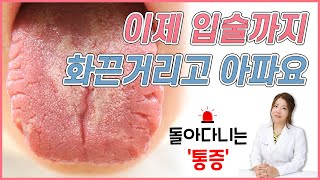 구강작열감증후군: 안 아프던 입술까지 화끈거리고 아파요