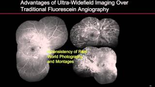 Ultra-Widefield Fluorescein Angiography in the Management of Diabetic Retinopathy