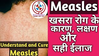 MEASLES  FULLY  EXPLAINED! खसरा रोग कि पूरी जानकारी। कारण, लक्षण और ईलाज। Hindi! Dr.K.S.Chougule.