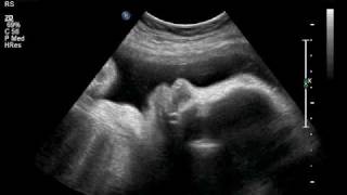 little billy ultrasound 34 weeks 015