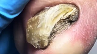 Dirty Onychomycosis, Very Hard, Trim Vigorously【Pedicure Master Lin Jun】