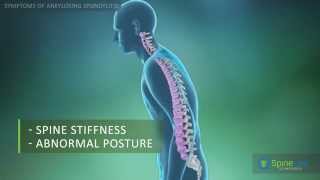 Ankylosing Spondylitis Symptoms