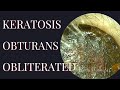 Keratosis Obturans Obliterated