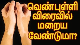 வெண்புள்ளி விரைவில் மறைய வேண்டுமா?