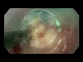 Tunnel removal of a submucosal tumor in the esophagus