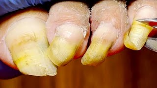 Extremely Long Toenails, Easily Trimmed【Xue Yidao Pedicure】