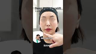 Deep Plane Face Liftでフェイスラインを引き上げる(BIANCA CLINIC)