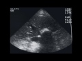 Sonography of the Gallbladder and Bile Ducts