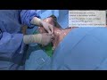 certofix® central venous catheter placement with ecg tip positioning standard seldinger needle