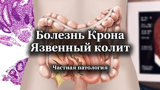 Болезнь Крона и язвенный колит | Частная патология