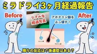 【報告】ミラドライ実施3ヶ月後の経過報告と口コミまとめ！ワキガ臭の周りの反応は？料金相場は？