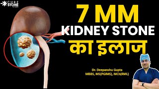 7mm Kidney Stone का इलाज कैसे होता है? | Treatment for 7 mm Kidney stones #kidneystone