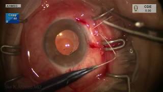 Scleral Spur Positioning for Suture Fixation