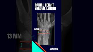 Distal radius fracture radiographic evaluation: Radial height