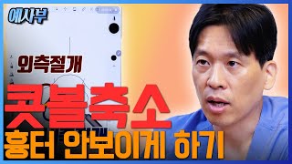 콧볼축소 흉터 안 남게 할 수 있을까?