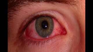 Eye Complaints in Urgent Care Medicine