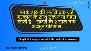 फांक होंठ की सर्जरी एक नई मुस्कान के साथ एक नया चेहरा लाती है - सर्जरी के 2 साल बाद अद्भुत परिणाम