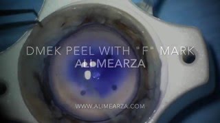 DMEK peel using \