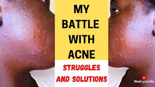 My Raw Acne Journey: Skincare Tips, Treatments \u0026 Self-Love | Why Your Acne Treatment Isn’t Working