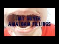 MY 7 SILVER AMALGAM TOOTH FILLINGS