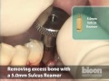 uncovering of a bicon short® implant