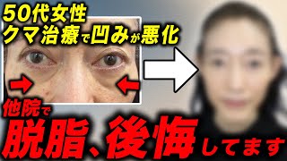 【クマ取り失敗】他院で脱脂を受けて失敗した50代女性の修正症例を紹介します