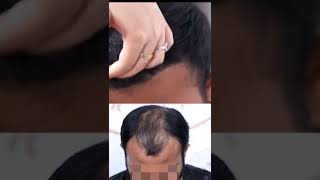 Best Hair Transplant Results Bangladesh | Bald 👨‍🦲 To Bold 👨|