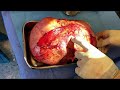 Retroperitoneal Sarcoma Resection (Embryonal rhabdomyosarcoma)