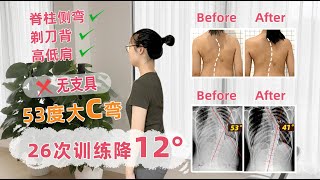 大腦學習訓練法12.5天-胸椎側彎53→41度 |@BLTM-for-Scoliosis