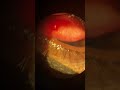 management of conjunctival concretions