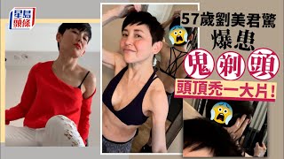 健康警號｜57歲劉美君驚爆患「鬼剃頭」頭頂禿一大片 母親早前證患腦瘤壓力爆煲