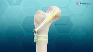 FNF - Femur Neck Fixation system