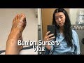 My Bunion Surgery Vlog | WOW, I Did Not EXPECT It to HURT THIS MUCH!