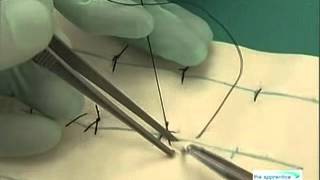 Continuous Interlocking Sutures