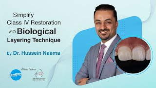 Simplify Class IV Restoration with Biological Layering Technique by Dr. Hussien Naama