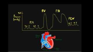 Schneid Guide to Cardiovascular Pressures with Right Heart Catheterization and Physical Exam