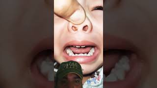 Something Stuck In Nose 😵  | How Doctor Remove It |        #shorts