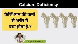 Calcium deficiency in Hindi | Calcium deficiency causes, symptoms \u0026 treatment in Hindi