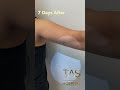 scarless armlift by dr.tas