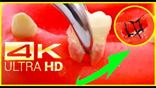 AMAZING: Tooth Extraction in 4k UNCUT!! Motorless tooth extraction surgery