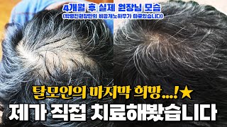 리제네라액티바 모낭줄기세포 탈모치료 꿈은 이루어진다 탈모인★ #강남삼성성형외과