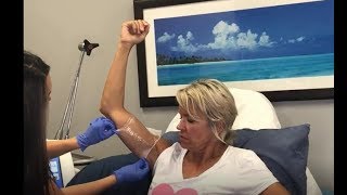 Coolsculpting Fat Reduction on Arms in Bucks County, PA at Healthy Solutions Medspa
