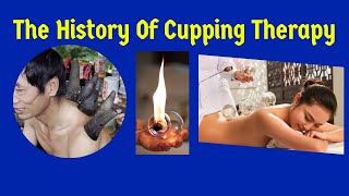 The History of Cupping Therapy: An Ancient Healing Practice