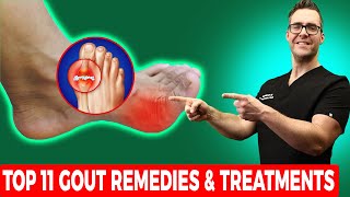 How to Cure Gout in Feet & Big Toe [Top 11 Gout Remedies & Treatments]