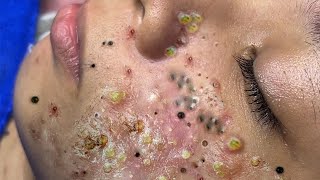 Big Cystic Acne Blackheads Extraction Blackheads \u0026 Milia, Whiteheads Removal Pimple Popping # 1720